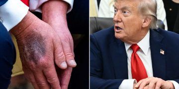 Doza e aspirinës dhe mavijosjet në duar, Trump sqaron gjendjen e tij shëndetësore