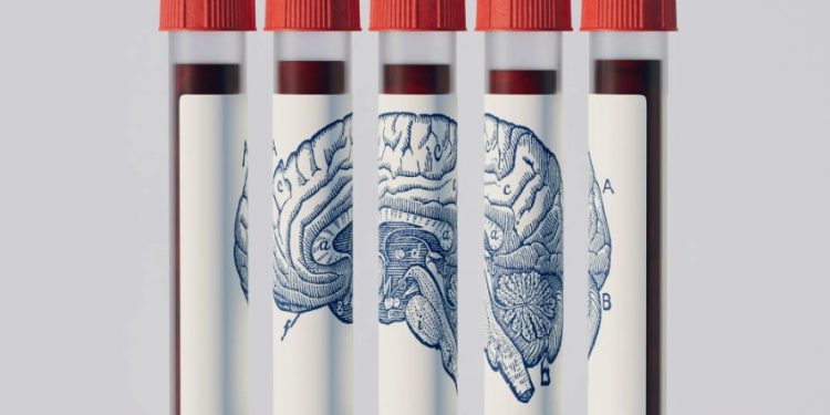A mund ta parashikojë një analizë gjaku Alzheimerin? Shkencëtarët japin përgjigjen