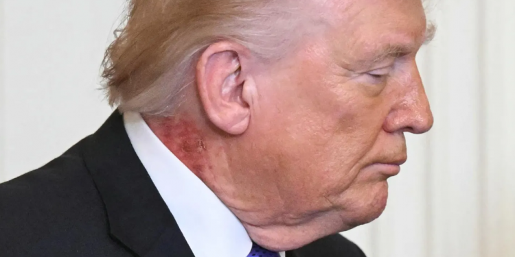 Mjeku i Trump: Skuqja në qafë lidhet me një trajtim parandalues të lëkurës